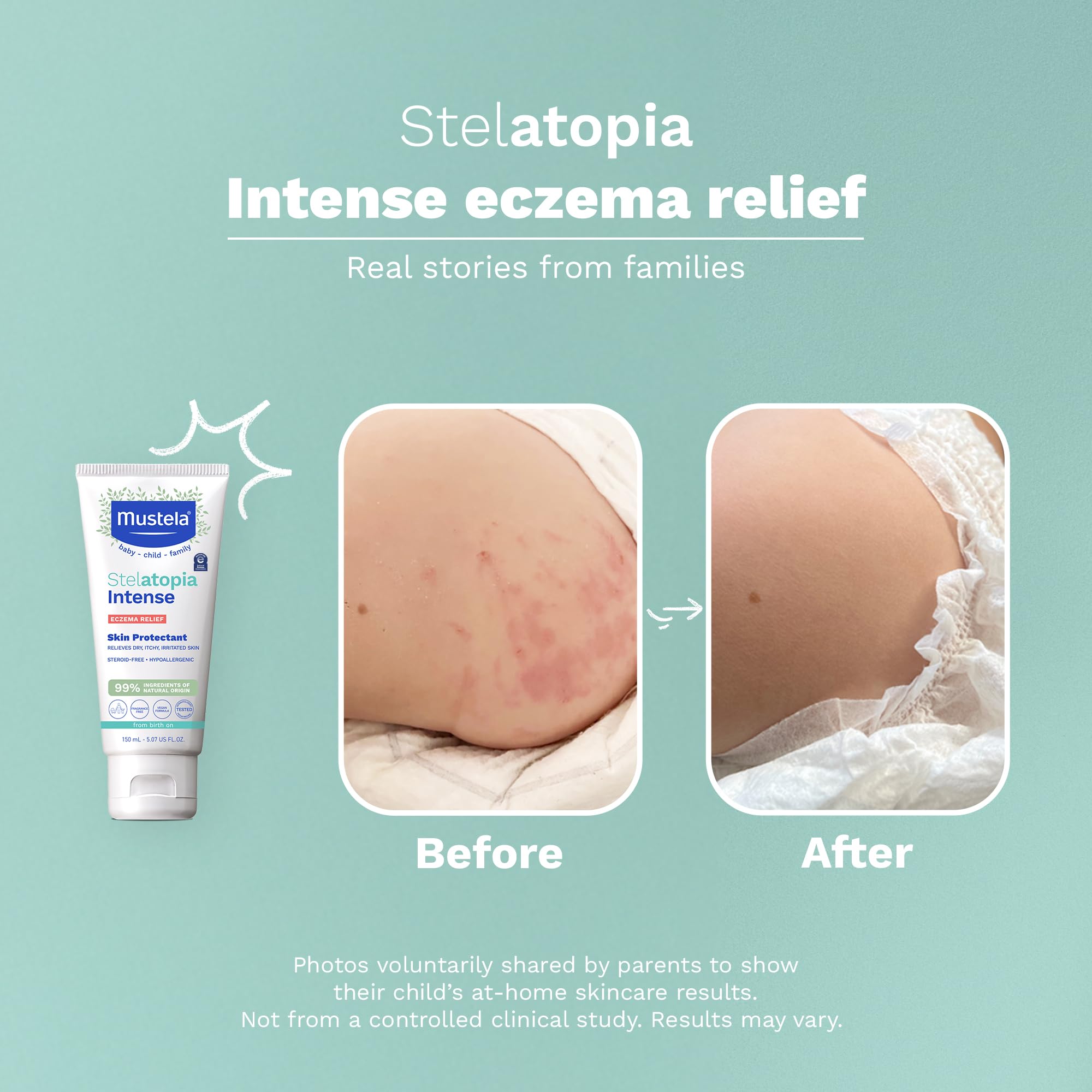 Mustela Stelatopia Intense - Non-Corticosteroid Cream | 30 ml