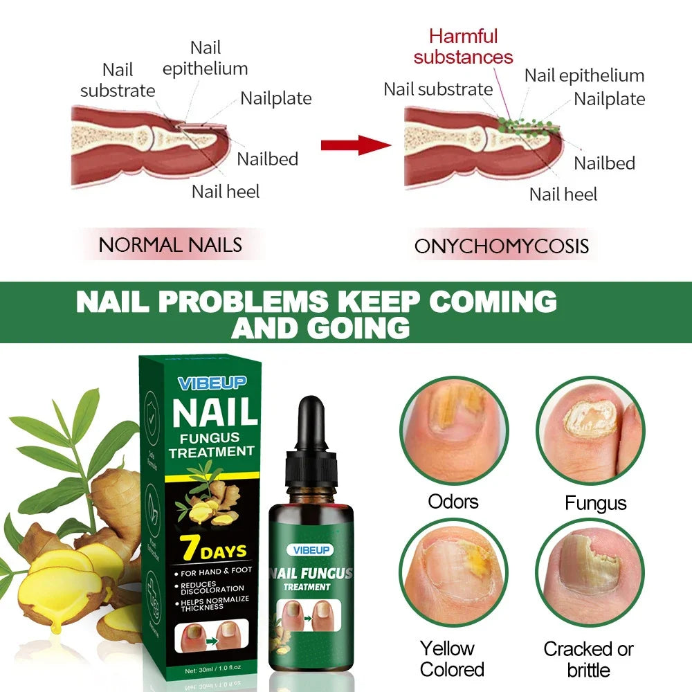 7 Days Fungal Nail Treatment Serum Foot Nail Fungus Removal Repair Gel Anti Infection Paronychia Onychomycosis Foot Nails Care